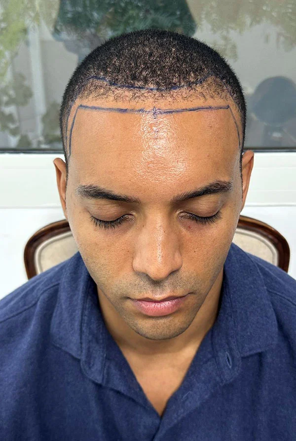 Patient undergoing surgical pre-op hairline marking for an Afro-textured hair transplant at Hair Clinic Dubai.