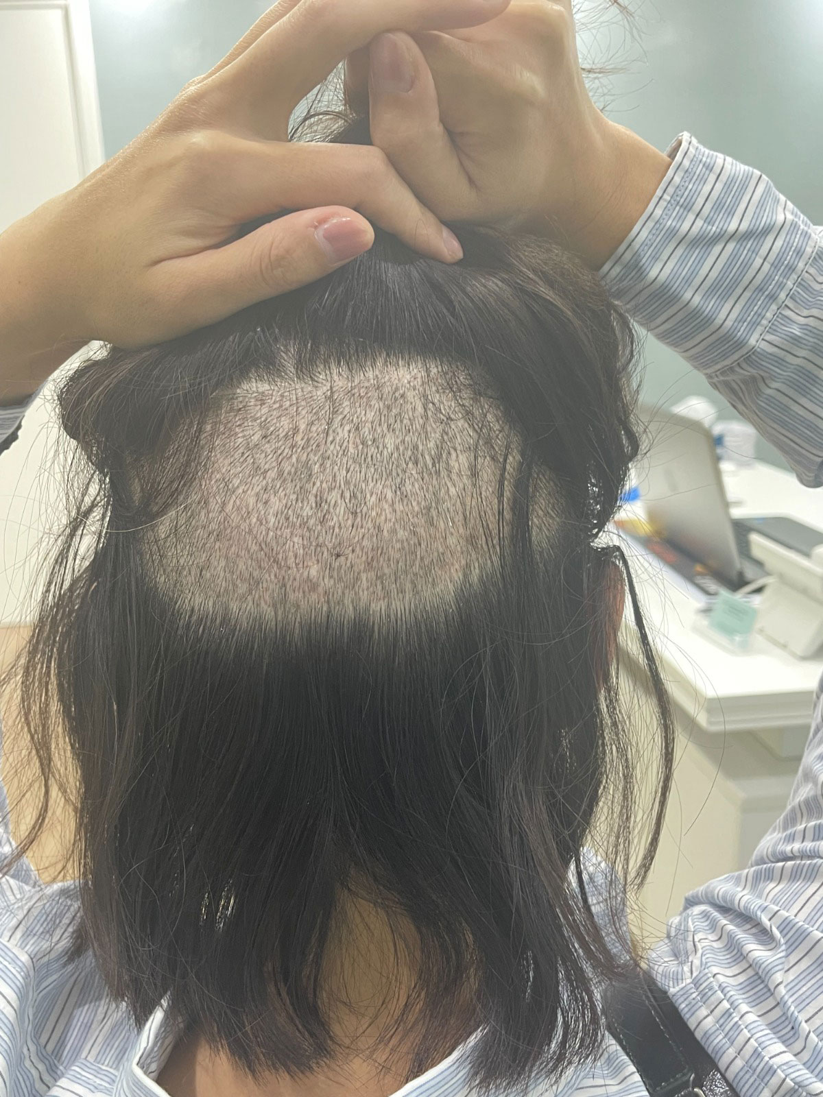 After 6 Days Overall Density View