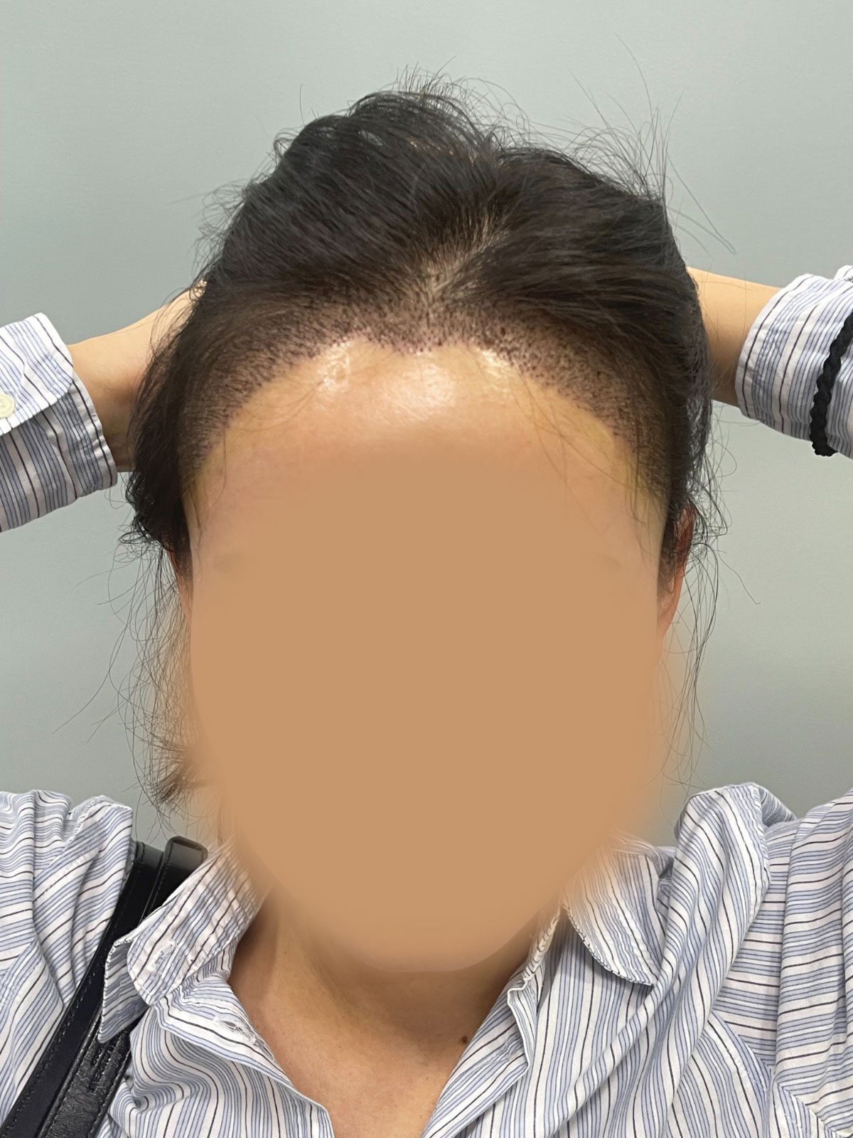 After 6 Days Healing Hairline Front View