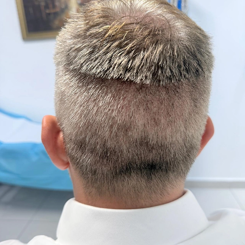 No-Shave FUE 7 Days Side View