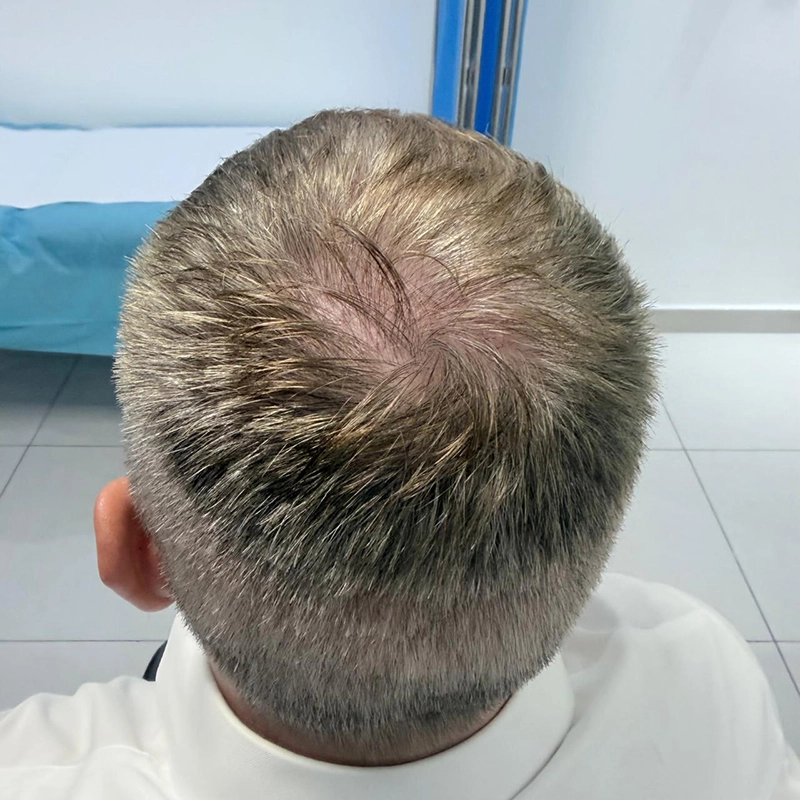 No-Shave FUE 7 Days Crown View