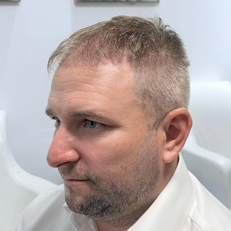No-Shave FUE 7 Days Full Hairline