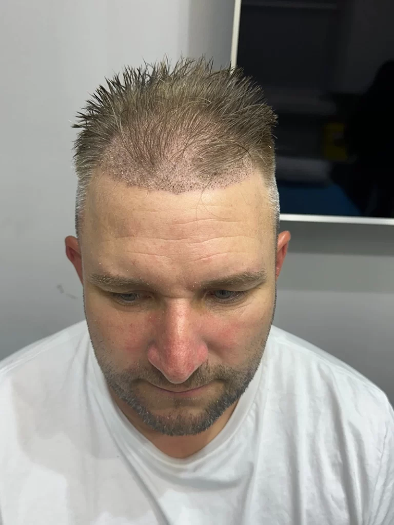 No-Shave FUE After 7 Days Front