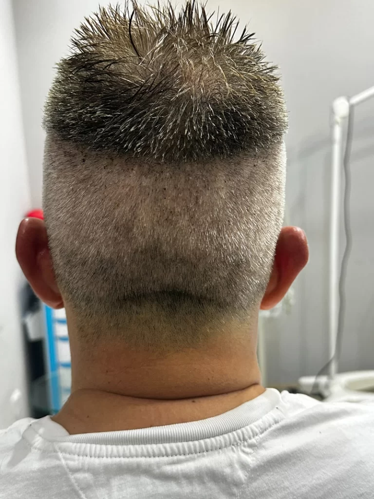 No-Shave FUE After 7 Days Donor