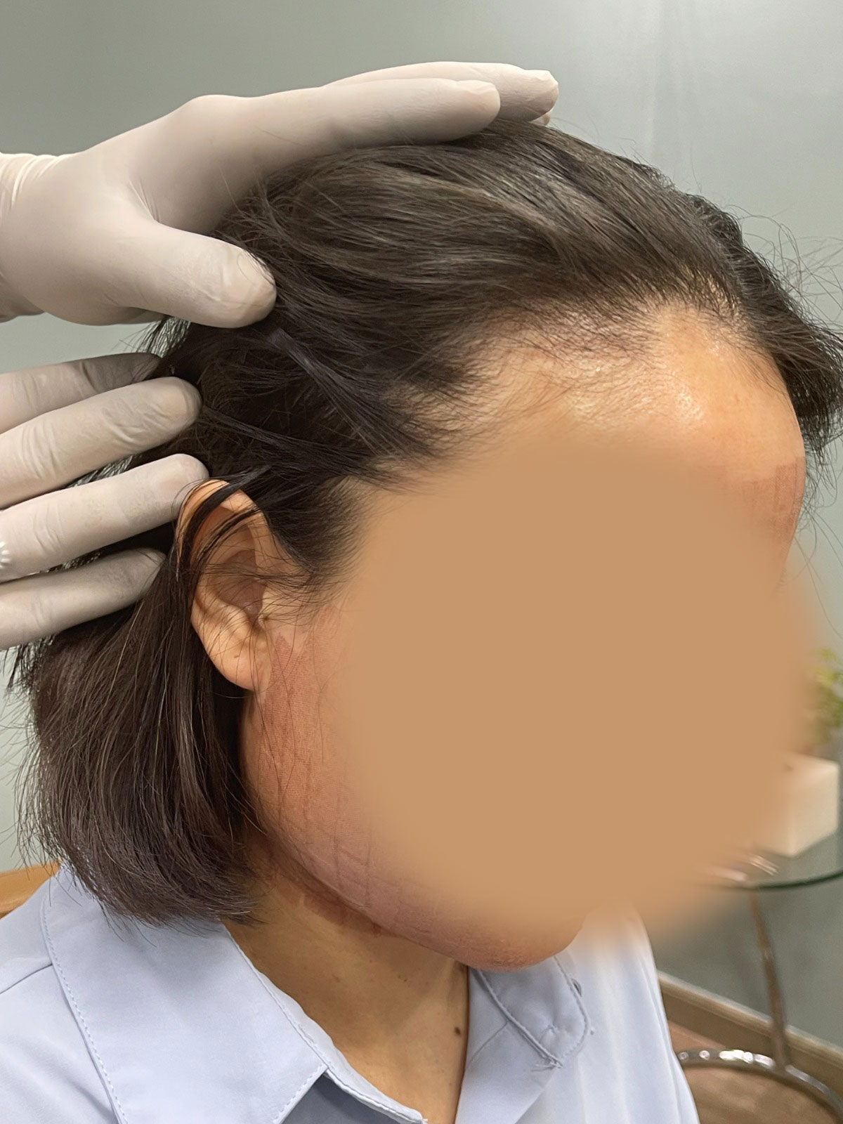 Hair Transplant Before Procedure Front View