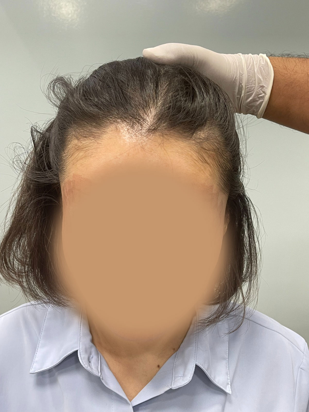 Hair Transplant Before Procedure Side Angle