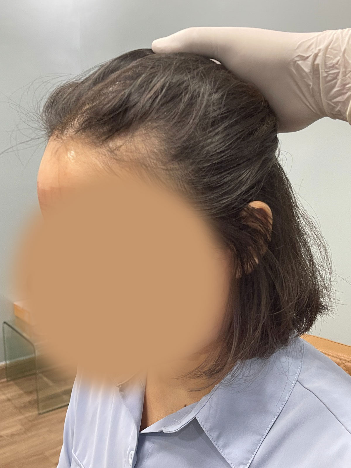 Hair Transplant Before Procedure Donor View