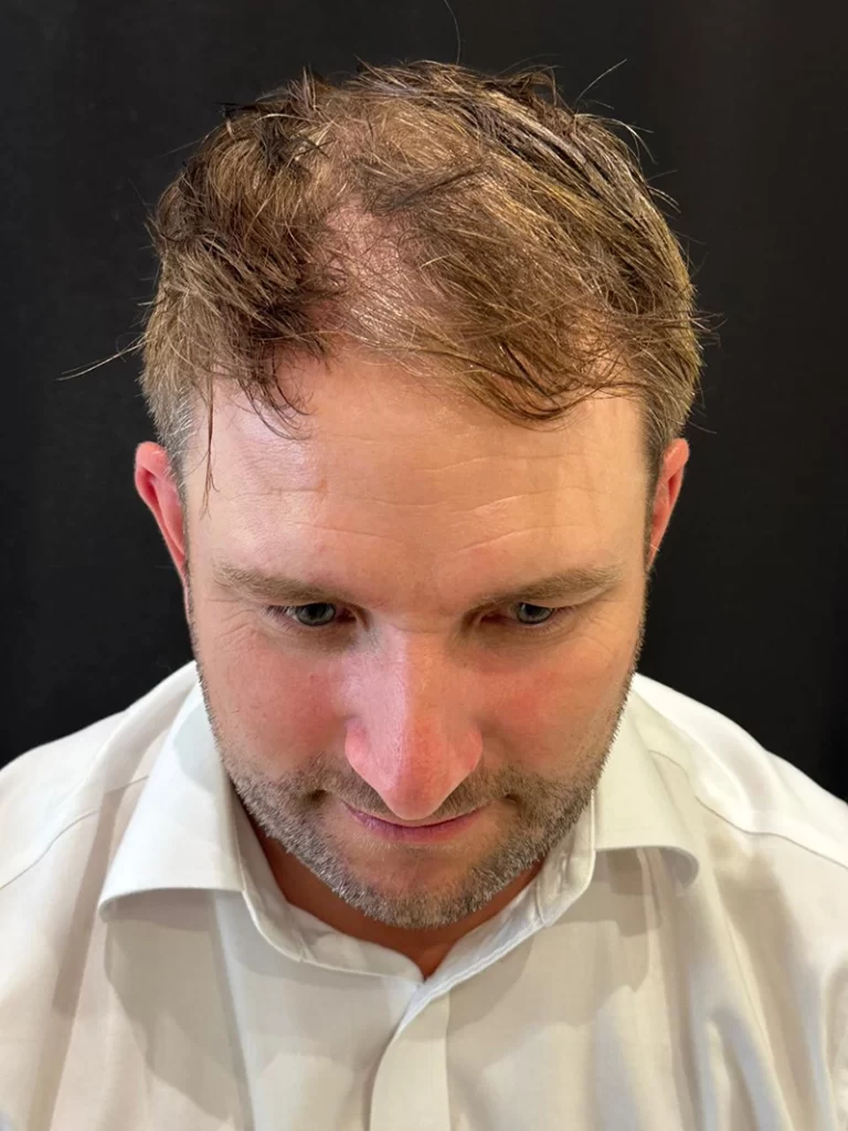 No-Shave FUE Before Front