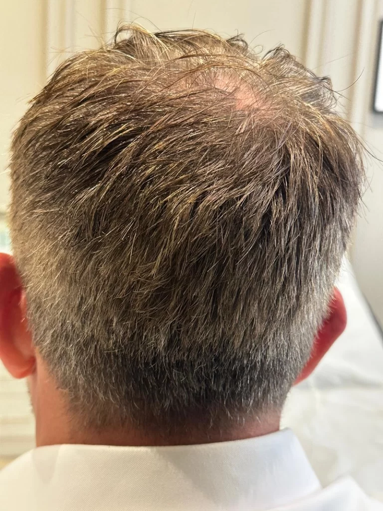 No-Shave FUE Before Donor