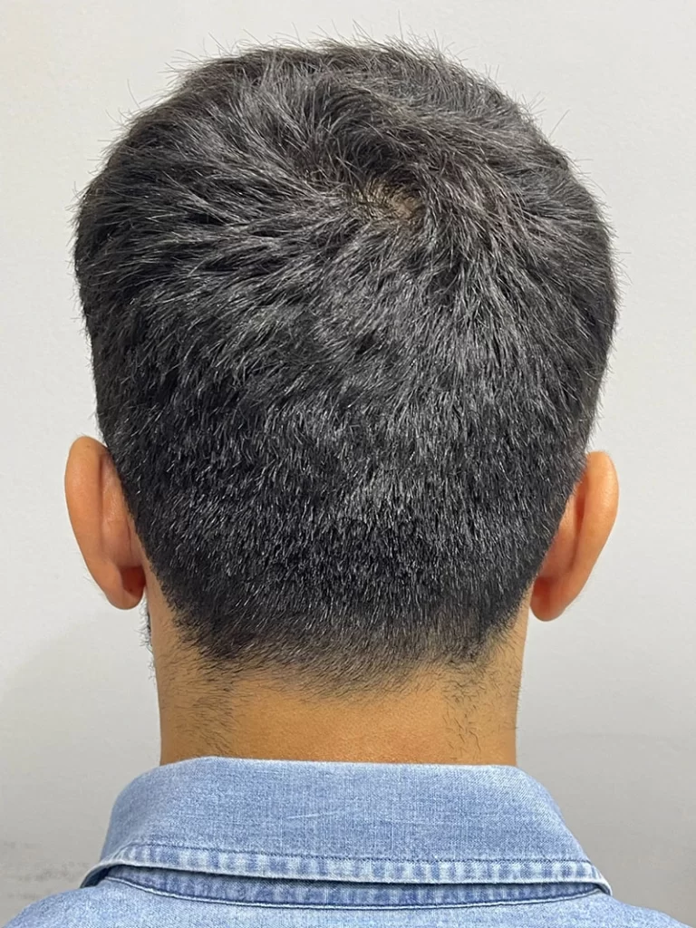 Hair Transplant Before