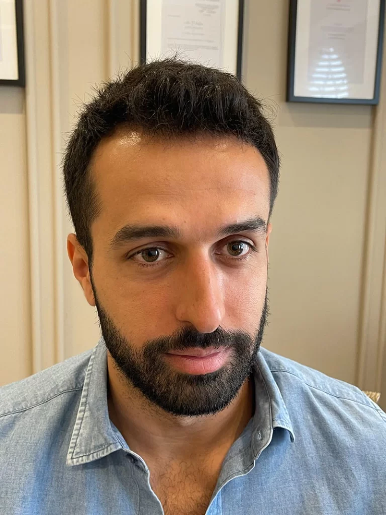 Hair Transplant Before