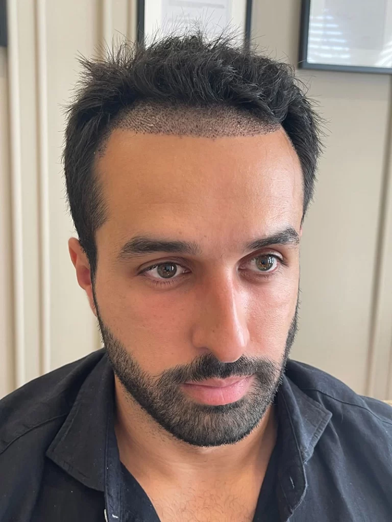 Hair Transplant After 4 Days