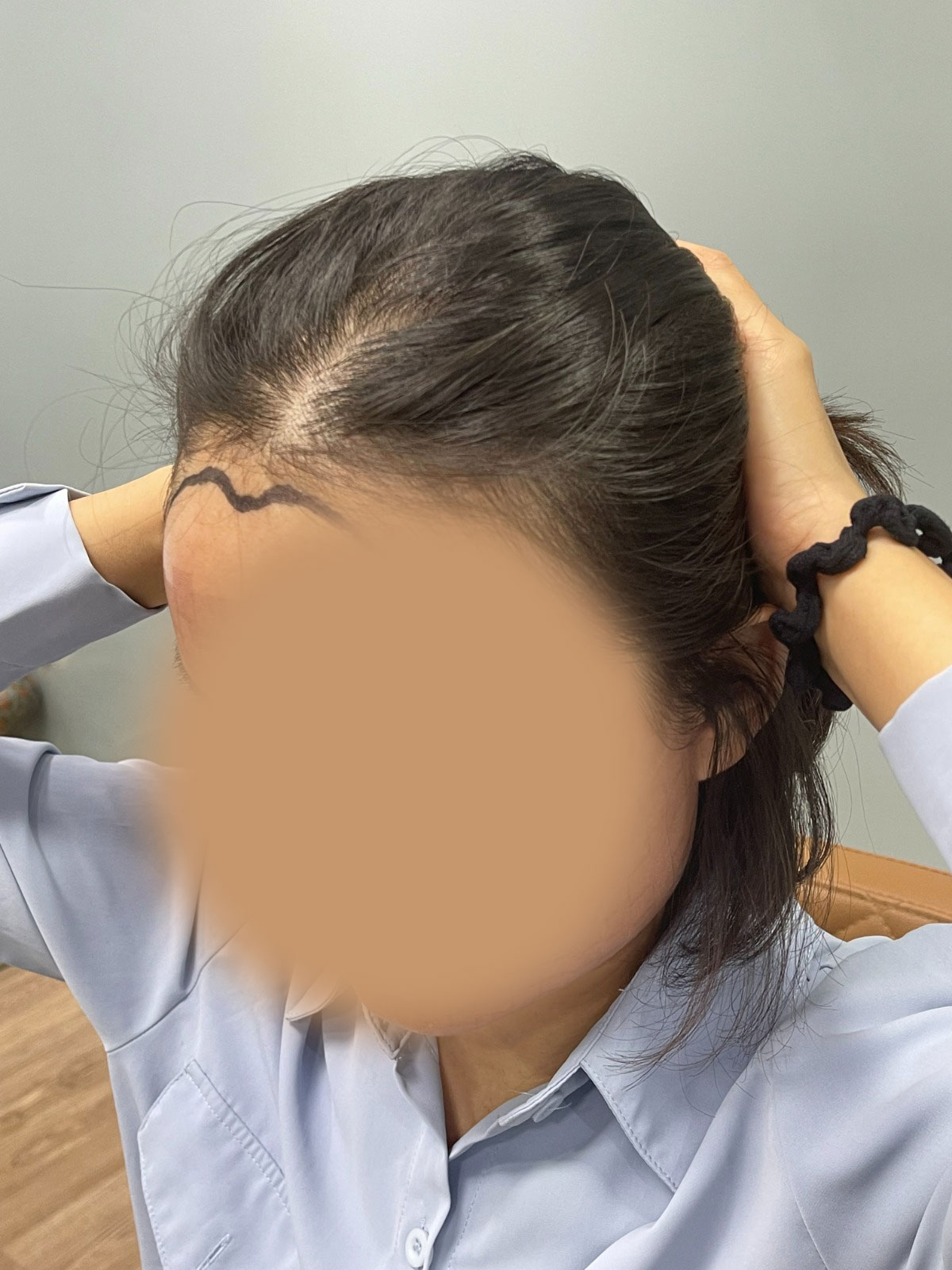 Day of Surgery Post Extraction Donor View