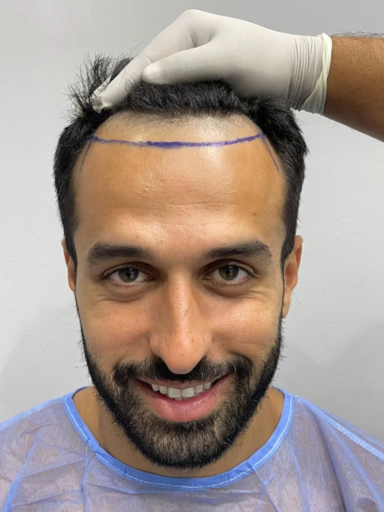 Hair Transplant Day of Surgery