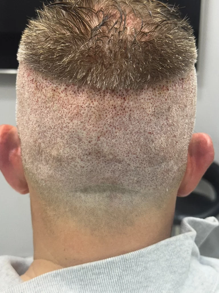 No-Shave FUE Next Day Donor