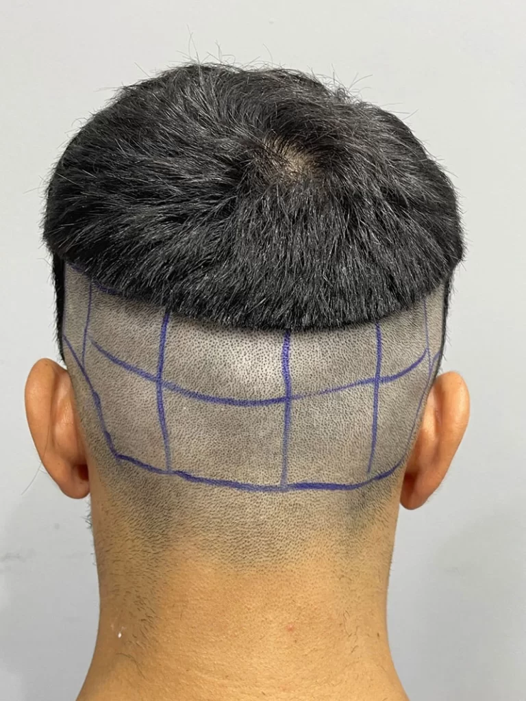 Hair Transplant Day of Surgery