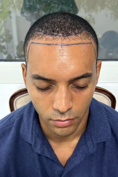 Patient undergoing surgical pre-op hairline marking for an Afro-textured hair transplant at Hair Clinic Dubai.