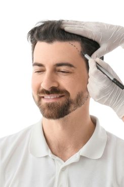 Hairline Transplant- hair clinic dubai